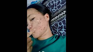 As Acne fighter Thank you Benzoyl peroxide 5 acne acnetreatment acneawareness acnejourney [upl. by Berkshire259]