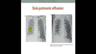 PleuralEffusionDiagnosticApproach [upl. by Ttirrem805]