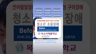 발음연습 조음치료 조음장애 dysarthria 혀운동 혀스트레칭 불수의적 혀근육 마비성 구어장애 Tongue paralysis muscle 혀마비 842 목소리재활학교 [upl. by Medwin582]