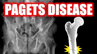 Paget Disease of Bone radiology doctor bones [upl. by Sada]