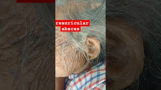 preauricular abscess [upl. by Micky]