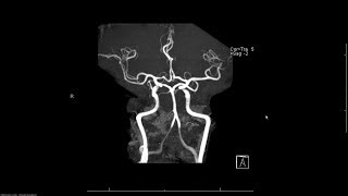 MRA magnetic resonance angiogram head radiology search pattern [upl. by Corie]