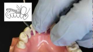 Ribbond Periodontal Splint Technique [upl. by Odnarb260]