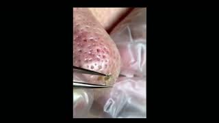 nose blackheads [upl. by Aneertak]