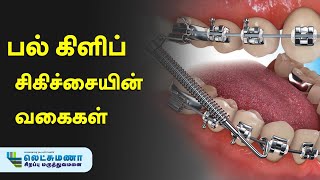 பல் கிளிப் சிகிச்சையின் வகைகள்  Types of Orthodontic Treatment [upl. by Alyat]