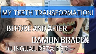 MY TEETH TRANSFORMATION  BEFORE AND AFTER BRACES [upl. by Loredo760]