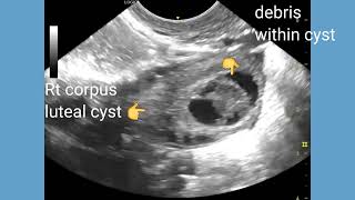 Viable intrauterine pregnancy with corpus luteal cyst of ovary ultrasound and color Doppler video [upl. by Yggam124]