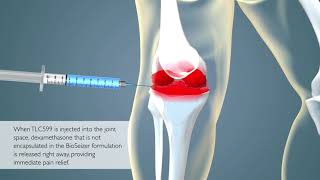 TLC599 Intraarticular Injection for Osteoarthritis Pain [upl. by Chrisy]