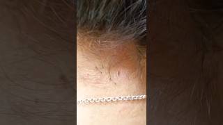 Lice Removal Part 5 shots funny [upl. by Farly]