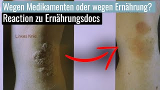 Psoriasis gezielt mit Ernährung lindern oder doch Medikamente  Reaction [upl. by Stenger]