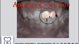 CrossBite Correction [upl. by Birdt]