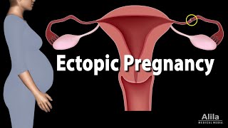 Ectopic Pregnancy Animation [upl. by Bilow272]