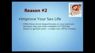 Natural Pearly Penile Papules Removal [upl. by Prospero270]