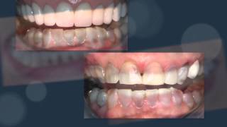 Stained Teeth Smile Improvement by Dr Craig Carlson [upl. by Adnwahsor366]