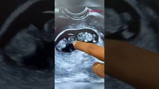 Early pregnancy scan  pregnancy confirmation  twin pregnancy  gynaecologist doctorsvlogs [upl. by Kcirderf]