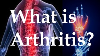 What is arthritis [upl. by Jacinto]