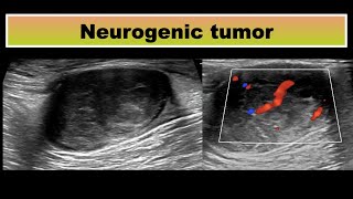 Neurogenic tumor in thigh [upl. by Yila757]