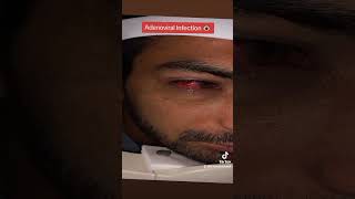 Adenoviral Eye Infection pinkeye ashobechashm ashob eye eyecarecentre eyedisorder lashes [upl. by Glaser]