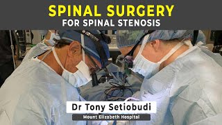 SURGERY FOR SPINAL STENOSIS [upl. by Sul]