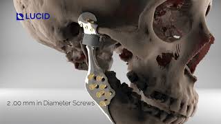 Total Joint Replacement TJR Animated Video  Custom TMJ Prosthesis [upl. by Aicire]