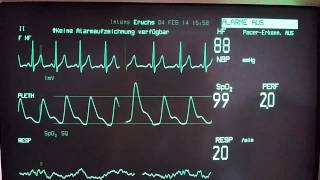 Ventricular Extrasystoles [upl. by Madeleine478]