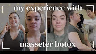 MY EXPERIENCE WITH MASSETER BOTOX for my TMJD  come get botox with me  a chat about skincare [upl. by Geilich]