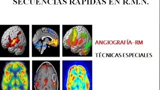 RESONANCIA MAGNÉTICA NUCLEAR 6 Secuencias rápidas y AngiografíaRMwmv [upl. by Enileme]