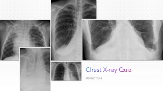 Chest Xray Quiz Atelectasis [upl. by Soilisav558]