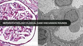 2024 11 19 Nephropathology Clinical Case Discussion Rounds [upl. by Audra]