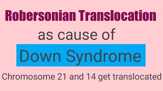 Robertsonian translocation as cause of Down syndrome downsyndromerobertsoniantranslocation [upl. by Einolem]