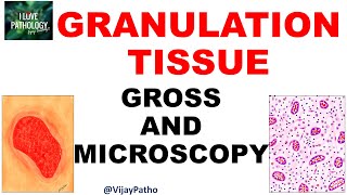 GRANULATION TISSUE  Pathology  Gross and Microscopy  Illustration  Draw With Me [upl. by Yticilef]