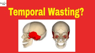 Cancer Wasting  Temporal Wasting  Wasting Syndrome  Malignant Cachexia [upl. by Einreb]