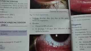 epidemic keratoconjunctivitis opthamology [upl. by Payson]