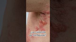 ¿La culebrilla es contagiosa  Dr William Guerrero medicina shorts [upl. by Rahmann]