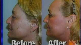 FRAXEL REPAIR  Dr Persky Facial Plastic Surgeon Encino Ca [upl. by Fabrianna]