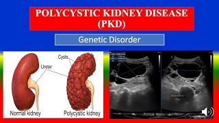 POLYCYSTIC KIDNEY DISEASE PKD  Definition types causes pathophysiology symptoms medicine [upl. by Yttam]