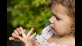 5 Easiest Ways to Remove a Splinter in a Child [upl. by Jo-Anne]