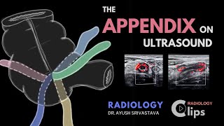 The Appendix on ultrasound and Acute appendicitis  Radiology [upl. by Orson]