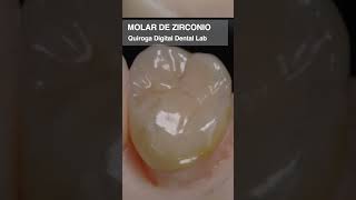 Molar de Zirconio impresión dental odontologia guayaquil ortodoncia sonrisa [upl. by Weingartner103]