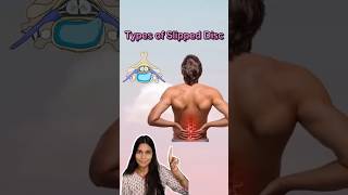 Types of slipped disc physiotherapy medicolife ytshorts physiotopics [upl. by Aiekam227]