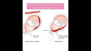 Placenta previa Cesarean sectiondoctor anatomy obstetrician nursing medicalstudent [upl. by Ahterahs]