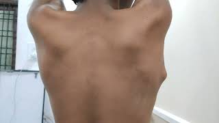 Osteochondroma Scapula  Very Interesting Case Dr Sai Chandra MBBS DNB Ortho [upl. by Anna]