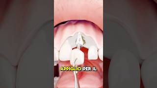 COME FUNZIONA IL TRAPIANTO DI DENTI credits ​⁠zackdfilms [upl. by James]