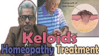 Keloids  Causes Symptoms and Treatment in Homeopathy by Dr PS Tiwari [upl. by Ahseia]