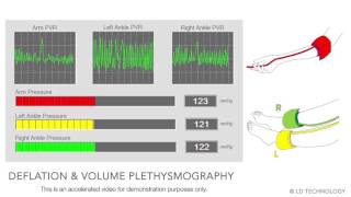 TMABI MEASUREMENT [upl. by Kaitlin]