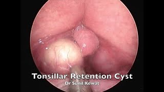 Tonsillar Retention Cyst  Incision and Drainage  Dr Sunil Kewat [upl. by Belicia904]