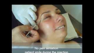 wrinkles injection sedation with MEOPA  kalinox [upl. by Cheryl]