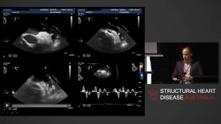 Detection of Left Atrial Thrombus  AProf Phillip Mottram [upl. by Anaejer917]