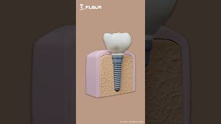 3D printed dental implant model Perfect for education and design showcase flsunprinter dental [upl. by Gayla24]