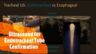 Confirm Endotracheal tube Placement with Ultrasound Perioperative amp Critical Care ECHO  POCUS [upl. by Attenaej]